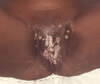This patient with secondary syphilis developed multiple vulvar and intertriginous condylomata lata lesions; these lesions typically appear as moist, gray, raised papules, often resembling warts (condyloma acuminata).