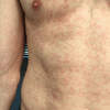 This patient with secondary syphilis developed a diffuse erythematous macular rash prominent on the chest, back, palms, and soles.