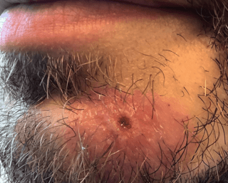 Mpox Lesion on Face