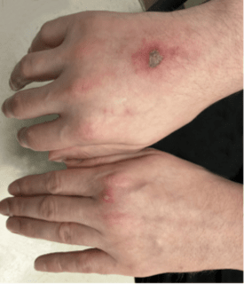 Pustular Rash on Hands