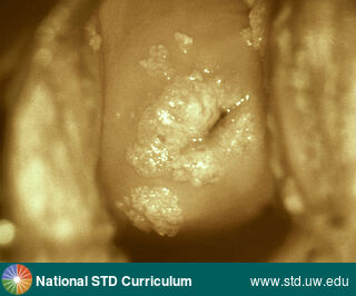 Diagnosis: HPV-Related Cancers, Warts (Anogenital), Clinical Signs: Papule / Papules, Verrucous, Locations: Cervix, Symptoms: Non-Painful, Image Type: Photo