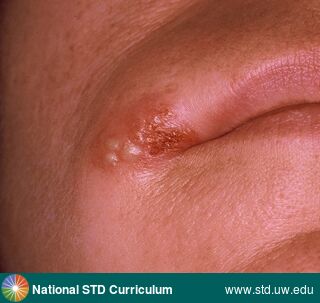 Diagnosis: HSV-type unknown, Clinical Signs: Erythema, Ulcer / Ulcers, Vesicle / Vesicles, Locations: Head, Lips, Symptoms: Painful, Image Type: Photo