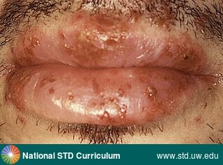 Diagnosis: HSV-type unknown, Clinical Signs: Erythema, Ulcer / Ulcers, Vesicle / Vesicles, Locations: Lips, Symptoms: Painful, Image Type: Photo