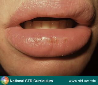 Diagnosis: HSV-type unknown, Clinical Signs: Edema / Swelling, Ulcer / Ulcers, Locations: Light skin tone, Lips, Symptoms: N/A, Image Type: Photo