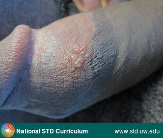 Diagnosis: HSV-type unknown, Clinical Signs: Vesicle / Vesicles, Locations: Dark skin tone, Penis, Symptoms: Painful, Image Type: Photo