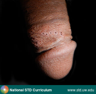 Diagnosis: HSV-type unknown, Clinical Signs: Scab, Locations: Penis, Symptoms: N/A, Image Type: Photo