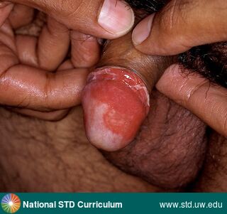 Diagnosis: HSV-type unknown, Clinical Signs: Ulcer / Ulcers, Locations: Penis, Symptoms: N/A, Image Type: Photo