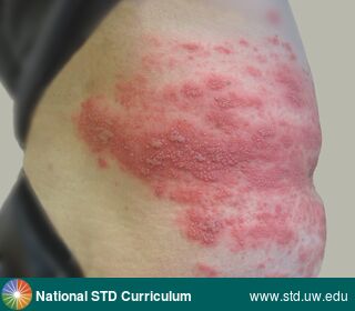Diagnosis: Herpes Zoster / Shingles, Zoster / Shingles, Clinical Signs: Erythema, Vesicle / Vesicles, Locations: Abdomen, Back, Symptoms: Painful, Image Type: Photo