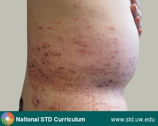 Diagnosis: Herpes Zoster / Shingles, Zoster / Shingles, Clinical Signs: Scab, Locations: Abdomen, Back, Symptoms: Rash, Image Type: Photo