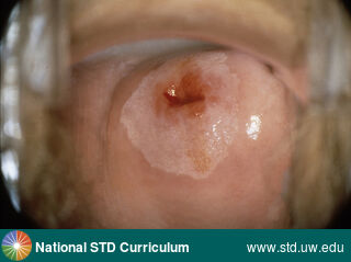 Diagnosis: Cervical Precancer (Dyplasia, LSIL, HSIL, CIN), Clinical Signs: N/A, Locations: Cervix, Symptoms: N/A, Image Type: Photo