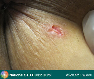 Diagnosis: HSV-type unknown, Clinical Signs: Ulcer / Ulcers, Locations: Anal / Perianal, Symptoms: N/A, Image Type: Photo