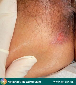 Diagnosis: Herpes-Genital, Clinical Signs: Ulcer / Ulcers, Locations: Anal / Perianal, Buttock, Symptoms: Painful, Image Type: Photo