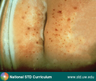 Diagnosis: Trichomoniasis, Clinical Signs: Discharge / Vagina / Cervix, Petchiae, Locations: Cervix, Symptoms: N/A, Image Type: Photo
