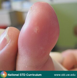 Diagnosis: Herpetic whitlow, Clinical Signs: Edema / Swelling, Erythema, Whitlow, Locations: Hand (Right), Light skin tone, Symptoms: Painful, Image Type: Photo