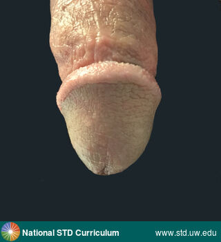 Diagnosis: Balanitis, Pearly penile papules, Clinical Signs: Papule / Papules, Locations: Light skin tone, Penis, Symptoms: Non-Painful, Image Type: Photo