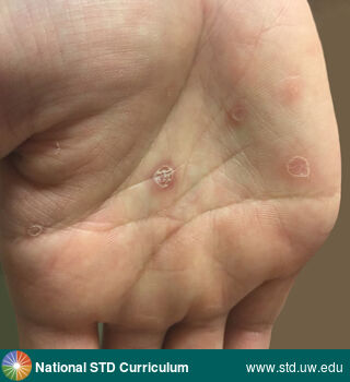 Diagnosis: Syphilis-Secondary, Clinical Signs: Macule / Macules, Papule / Papules, Plaque, Rash, Scale, Locations: Hand (Left), Hand (Right), Light skin tone, Symptoms: N/A, Image Type: Photo