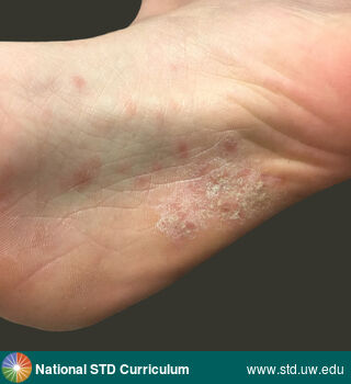 Diagnosis: Syphilis-Secondary, Clinical Signs: Macule / Macules, Papule / Papules, Plaque, Rash, Scale, Locations: Feet/Soles, Light skin tone, Symptoms: N/A, Image Type: Photo