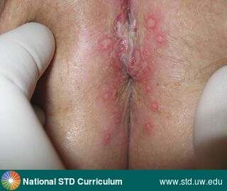 Diagnosis: HSV-type unknown, Clinical Signs: Lesion, Ulcer / Ulcers, Locations: Anal / Perianal, Light skin tone, Vulva, Symptoms: Painful, Image Type: Photo