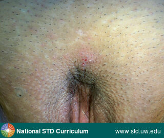 Diagnosis: HSV-type unknown, Clinical Signs: Lesion, Ulcer / Ulcers, Vesicle / Vesicles, Locations: Light skin tone, Vulva, Symptoms: N/A, Image Type: Photo