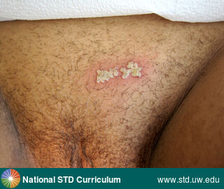 Diagnosis: HSV-type unknown, Clinical Signs: Erythema, Papule / Papules, Vesicle / Vesicles, Locations: Abdomen, Dark skin tone, Suprapubic (Hypogastrium), Symptoms: Painful, Image Type: Photo