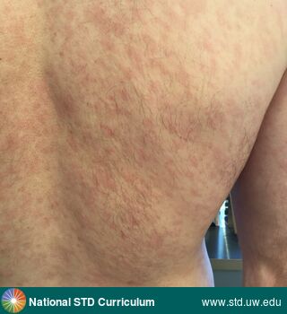 Diagnosis: Syphilis-Secondary, Clinical Signs: Erythema, Macule / Macules, Rash, Locations: Back, Light skin tone, Symptoms: Itch, Non-Painful, Rash, Image Type: Photo