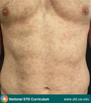 Diagnosis: Syphilis-Secondary, Clinical Signs: Erythema, Macule / Macules, Locations: Abdomen, Chest, Light skin tone, Symptoms: Itch, Non-Painful, Rash, Image Type: Photo