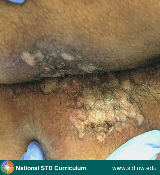 Diagnosis: HPV-Related Cancers, Syphilis-Secondary, Clinical Signs: Plaque, Verrucous, Locations: Anal / Perianal, Buttock, Dark skin tone, Symptoms: N/A, Image Type: Photo