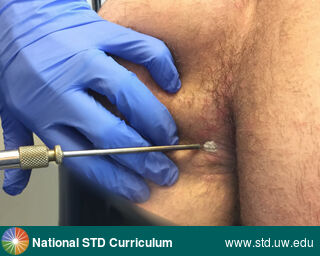 Diagnosis: HPV-Related Cancers, Warts (Anogenital), Clinical Signs: Verrucous, Locations: Anal / Perianal, Buttock, Symptoms: N/A, Image Type: Photo