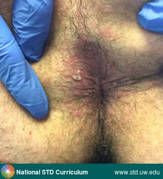 Diagnosis: HPV-Related Cancers, Warts (Anogenital), Clinical Signs: Verrucous, Locations: Anal / Perianal, Buttock, Symptoms: N/A, Image Type: Photo