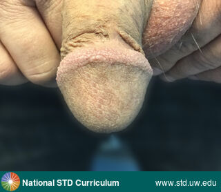 Diagnosis: Pearly penile papules, Clinical Signs: Papule / Papules, Locations: Light skin tone, Penis, Symptoms: Non-Itchy, Non-Painful, Image Type: Photo