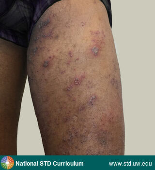 Diagnosis: Herpes Zoster / Shingles, Zoster / Shingles, Clinical Signs: Erythema, Vesicle / Vesicles, Locations: Dark skin tone, Thigh, Symptoms: N/A, Image Type: Photo