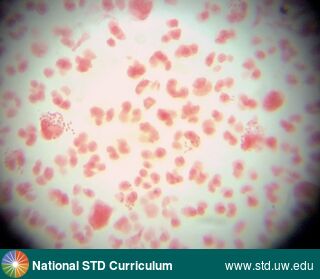 Diagnosis: Gonorrhea, Clinical Signs: N/A, Locations: Microscope-Gram Stain, Symptoms: N/A, Image Type: Photo