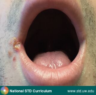 Diagnosis: Herpes simplex virus-2, Clinical Signs: Ulcer / Ulcers, Locations: Face, Lips, Symptoms: N/A, Image Type: Photo
