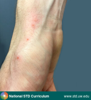 Diagnosis: Scabies, Clinical Signs: Papule / Papules, Locations: Arm (Right), Hand (Right), Symptoms: Itch, Image Type: Photo