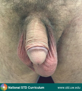 Diagnosis: Epididymitis, Gonorrhea, Clinical Signs: Edema / Swelling, Locations: Epididymis, Light skin tone, Scrotum, Symptoms: Painful, Image Type: Photo