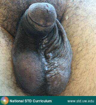 Diagnosis: Warts (Anogenital), Clinical Signs: Papule / Papules, Verrucous, Locations: Dark skin tone, Penis, Scrotum, Symptoms: N/A, Image Type: Photo
