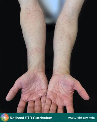 Diagnosis: Syphilis-Secondary, Clinical Signs: Erythema, Macule / Macules, Rash, Locations: Arm (Left), Arm (Right), Hand (Left), Hand (Right), Symptoms: Rash, Image Type: Photo