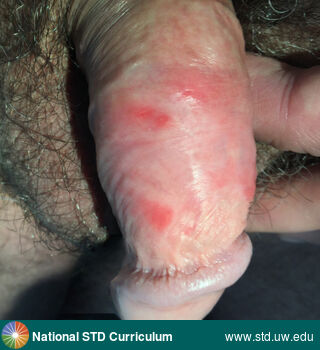 Diagnosis: Herpes simplex virus-1, Clinical Signs: Erythema, Lesion, Ulcer / Ulcers, Locations: Penis, Symptoms: Painful, Image Type: Photo