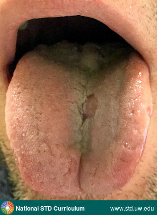 Diagnosis: Syphilis-Primary, Clinical Signs: Ulcer / Ulcers, Locations: Light skin tone, Tongue, Symptoms: Non-Painful, Image Type: Photo