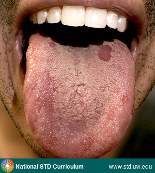 Diagnosis: Syphilis-Secondary, Clinical Signs: Annular, Patch/Patches, Locations: Tongue, Symptoms: Non-Painful, Image Type: Photo