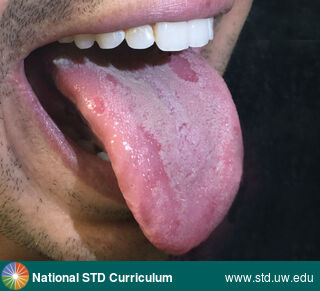 Diagnosis: Syphilis-Secondary, Clinical Signs: Annular, Patch/Patches, Locations: Tongue, Symptoms: Non-Painful, Image Type: Photo