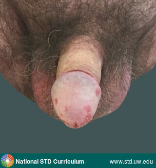 Diagnosis: Psoriasis, Clinical Signs: Erythema, Plaque, Rash, Scale, Locations: Penis, Symptoms: Itch, Rash, Image Type: Photo