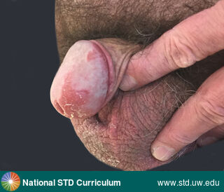 Diagnosis: Psoriasis, Clinical Signs: Erythema, Plaque, Rash, Scale, Locations: Penis, Symptoms: Itch, Rash, Image Type: Photo