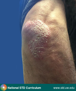 Diagnosis: Psoriasis, Clinical Signs: Plaque, Rash, Scale, Locations: Arm (Left), Symptoms: Itch, Rash, Image Type: Photo
