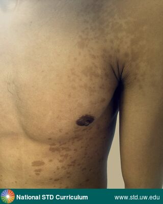 Diagnosis: Tinea versicolor, Clinical Signs: Hyperpigmentation, Macule / Macules, Rash, Locations: Chest, Dark skin tone, Shoulder (Left), Symptoms: Itch, Rash, Image Type: Photo