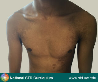 Diagnosis: Tinea versicolor, Clinical Signs: Hyperpigmentation, Macule / Macules, Rash, Locations: Chest, Dark skin tone, Symptoms: Itch, Rash, Image Type: Photo