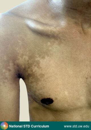 Diagnosis: Pityriasis versicolor, Clinical Signs: Hyperpigmentation, Macule / Macules, Rash, Locations: Chest, Dark skin tone, Shoulder (Right), Symptoms: Itch, Rash, Image Type: Photo