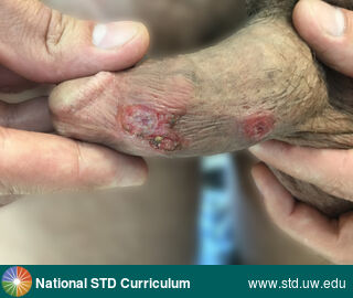 Diagnosis: Syphilis-Primary, Clinical Signs: Lesion, Ulcer / Ulcers, Locations: Penis, Symptoms: N/A, Image Type: Photo