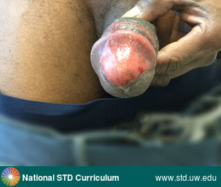 Diagnosis: Fixed Drug Eruption, Clinical Signs: Hypopigmentation, Lesion, Patch/Patches, Ulcer / Ulcers, Locations: Dark skin tone, Penis, Symptoms: N/A, Image Type: Photo