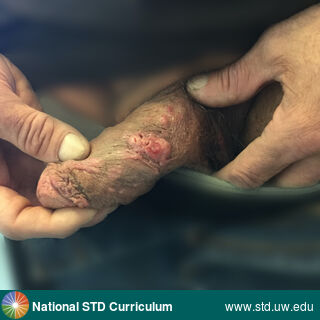 Diagnosis: Syphilis-Primary, Syphilis-Secondary, Clinical Signs: Lesion, Papule / Papules, Rash, Locations: Penis, Symptoms: N/A, Image Type: Photo